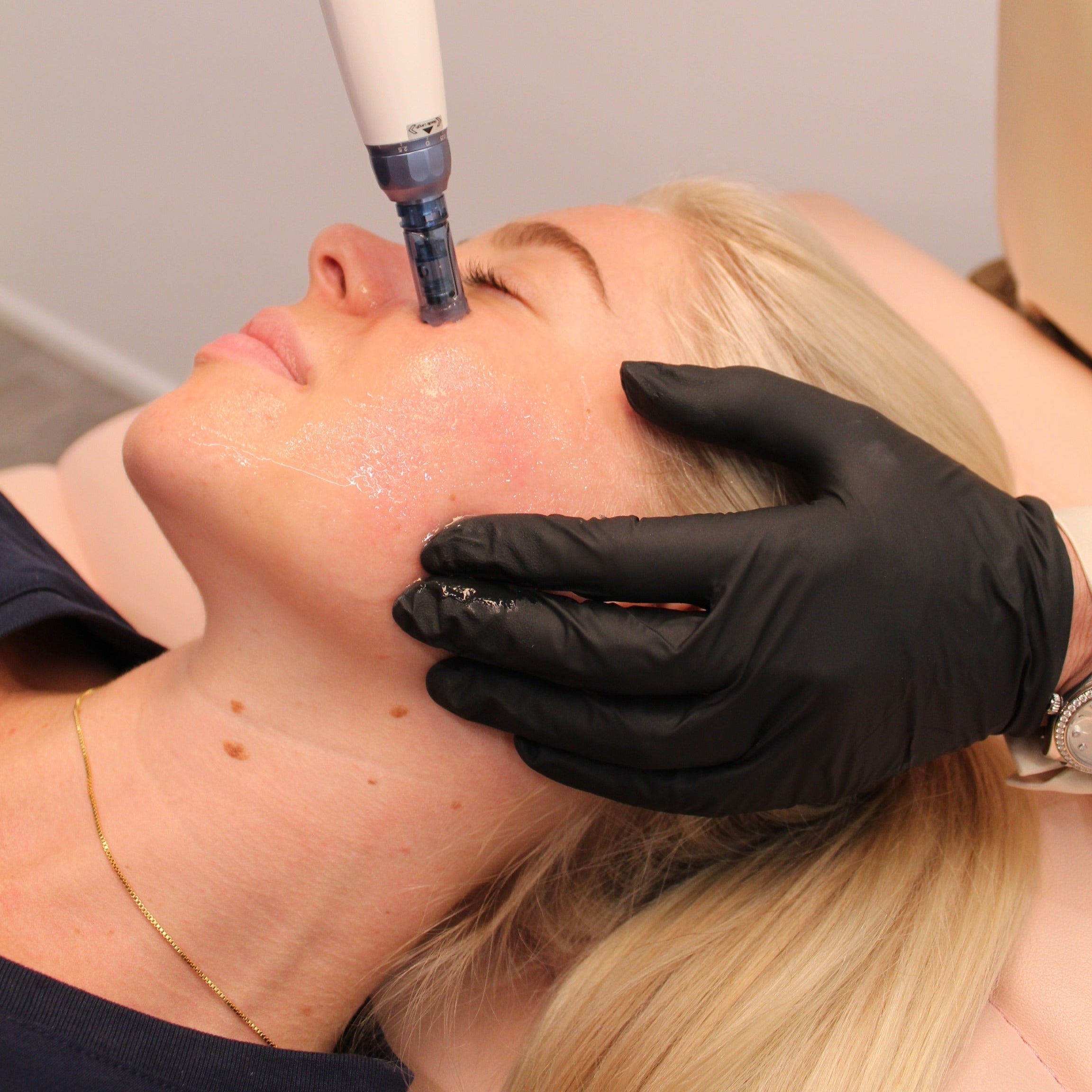 MEDICAL-GRADE SKIN NEEDLING