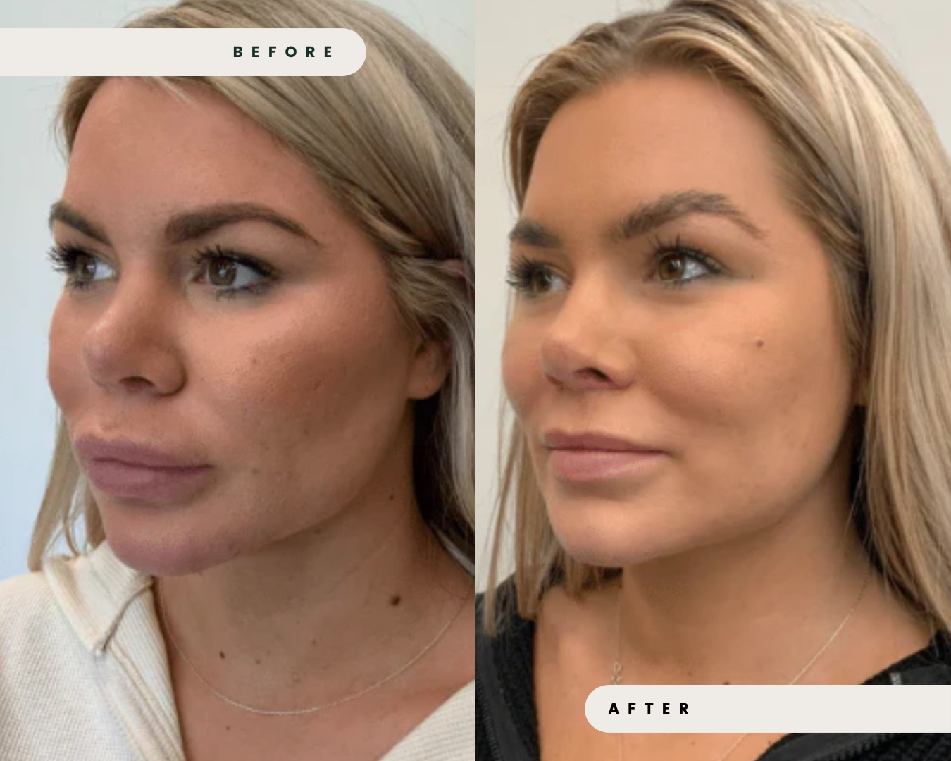 DERMAL_FILLER_DISSOLVER_2_baf23d15-20ba-496e-aceb-43e2348d7248.png