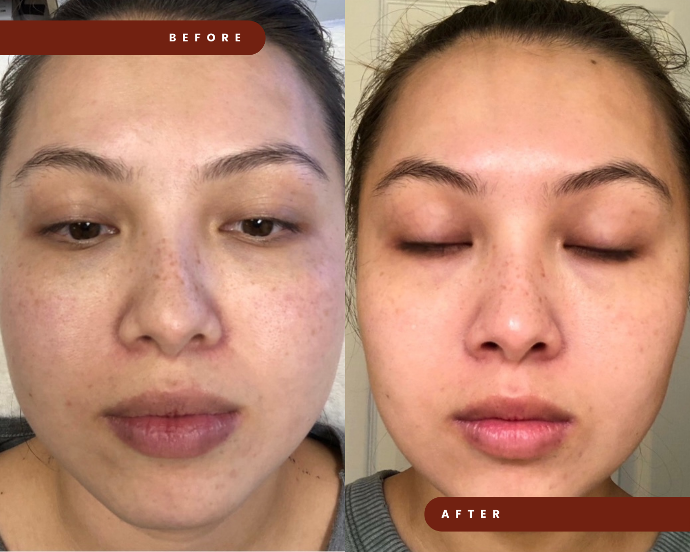 Before and after facial slimming treatment with Masseter Botox at Mel Hornery Cosmetics, showcasing noticeable reduction in jawline width and enhanced facial contours