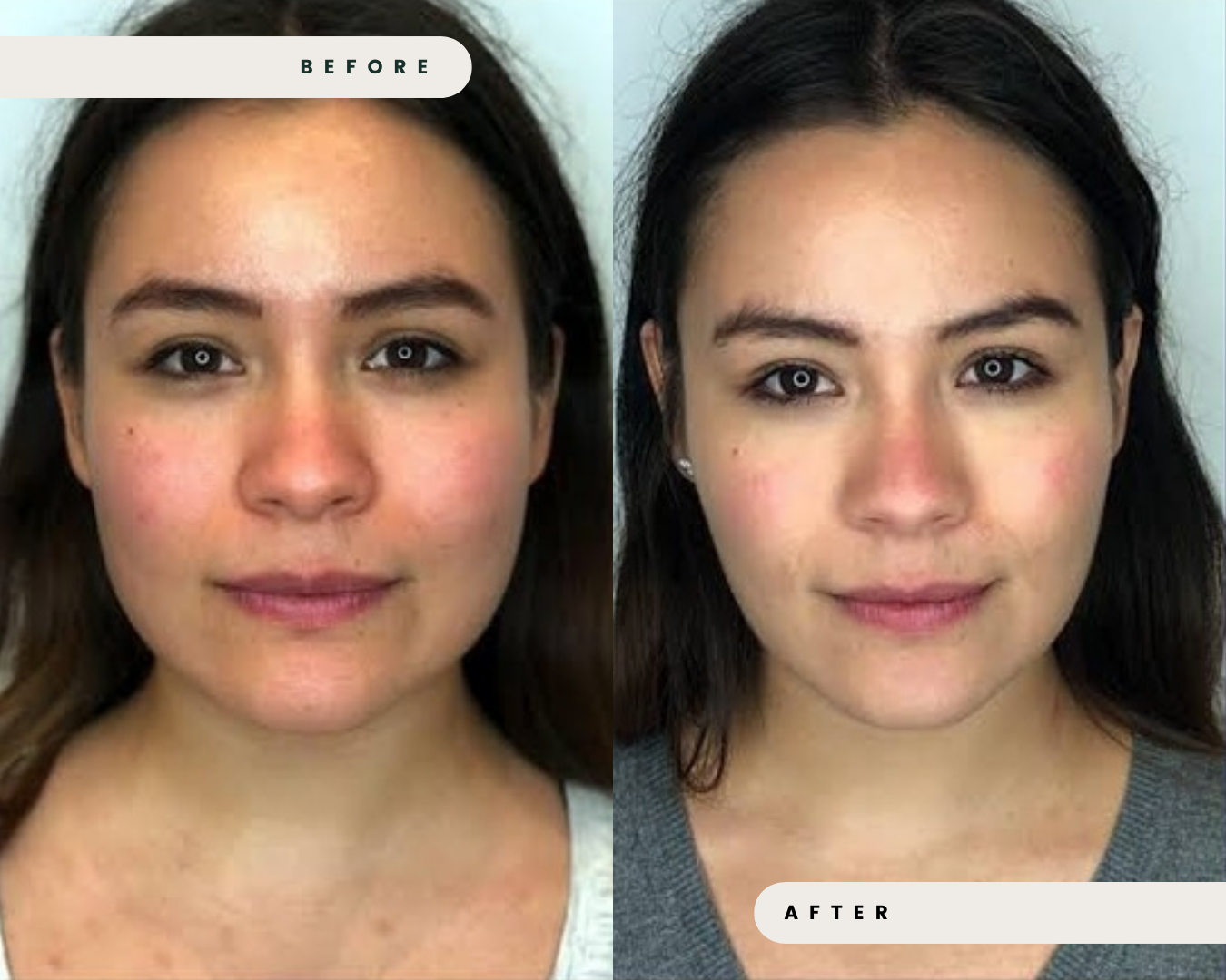 FACIAL_SLIMMING___EXCESSIVE_GRINDING_2.png