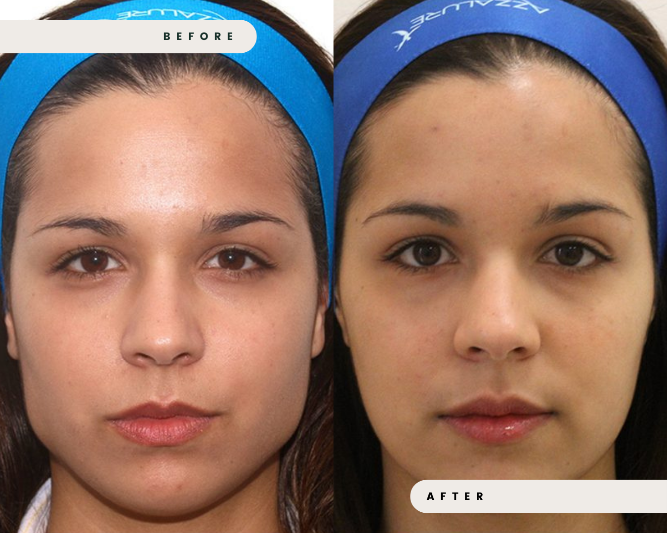 FACIAL_SLIMMING___EXCESSIVE_GRINDING_3.png