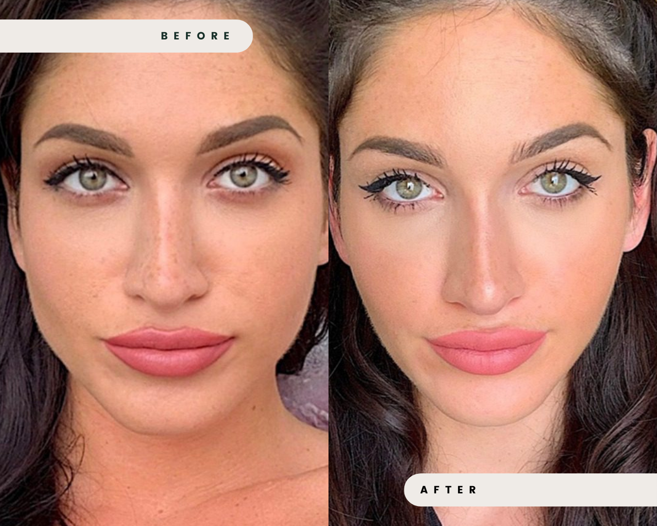 FACIAL_SLIMMING___EXCESSIVE_GRINDING_4.png