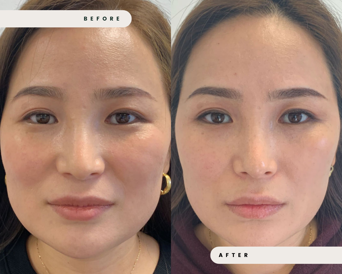 FACIAL_SLIMMING___EXCESSIVE_GRINDING_5.png