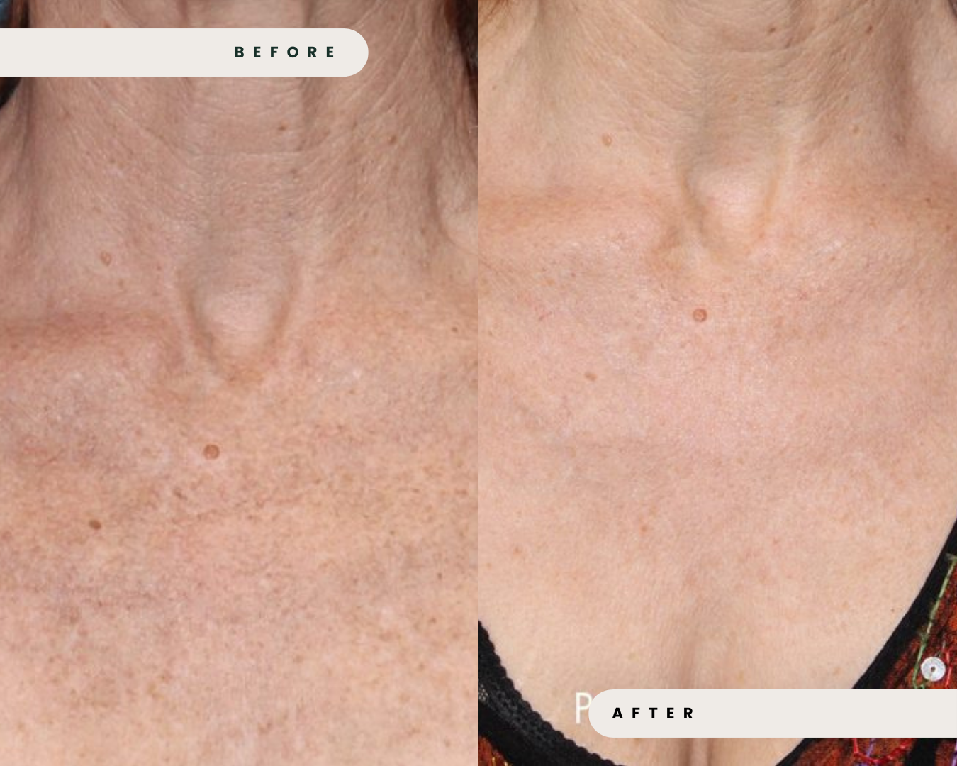 LIMELIGHT_IPL_FOR_ACTIVE_ACNE_3_abff41a7-0daf-41ad-b96b-87987c86cc2b.png