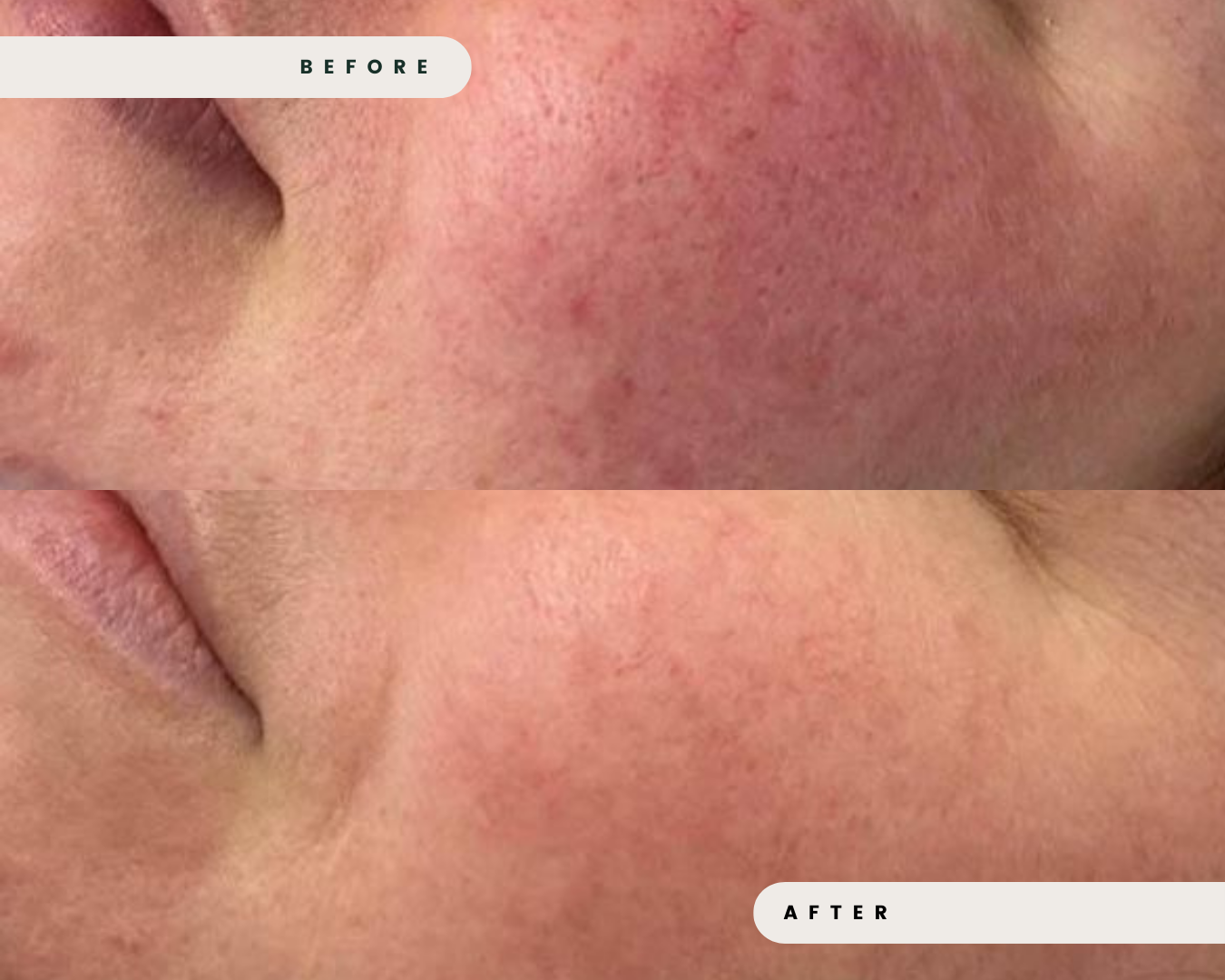 LIMELIGHT_IPL_FOR_ACTIVE_ACNE_4_d90155fa-94b5-419c-9123-ebe186c77ecf.png