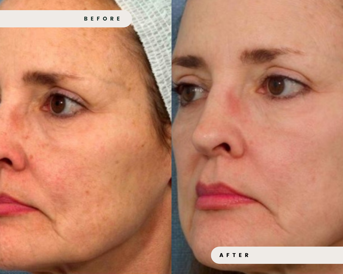 LIMELIGHT_IPL_FOR_REDNESS_ROSACEA_CAPILLARIES_1_995f8f1c-0ad7-4dcd-9b97-9fb7b008fec6.png