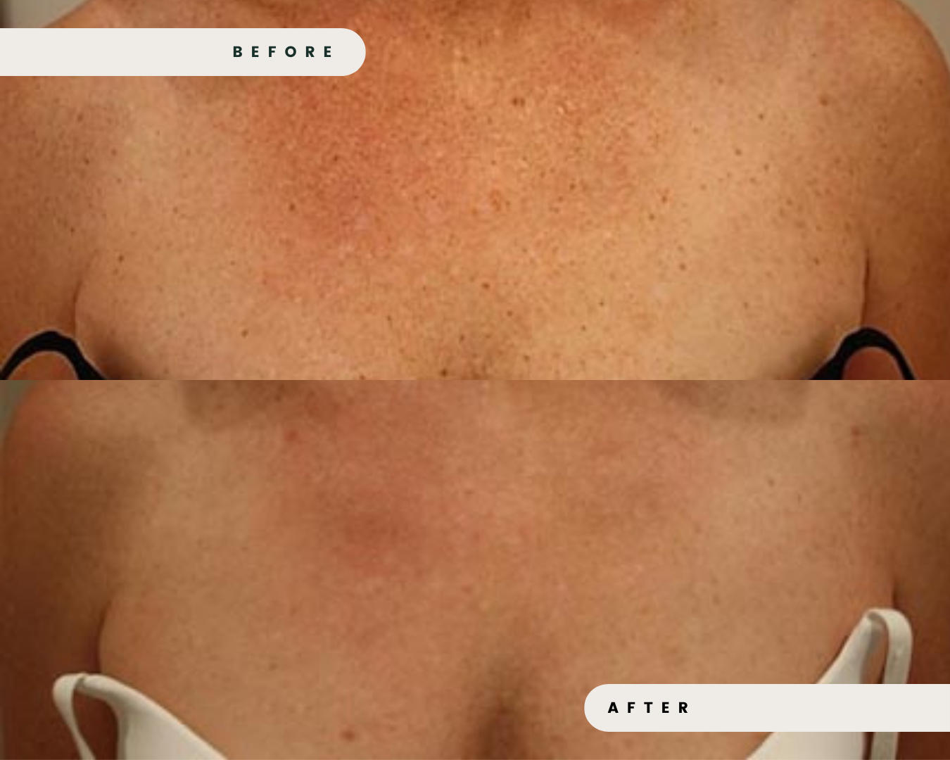 LIMELIGHT_IPL_FOR_REDNESS_ROSACEA_CAPILLARIES_4_de664c9a-7c07-47ec-9ef2-f9ffea0fb4d7.png