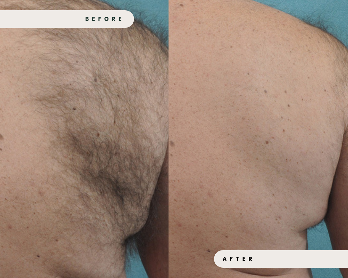 PROWAVE_IPL_HAIR_REMOVAL_2_0073beaa-ef18-415f-8ac6-2af71ba49f7e.png