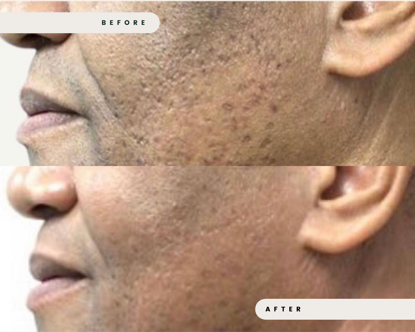 SKINPEN_MICRONEEDLING_4.png