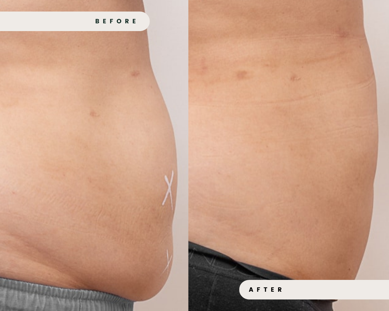 TRUSCULPT_FAT_REDUCTION_1_9927456a-52b1-41c8-994e-266757ceb45d.png