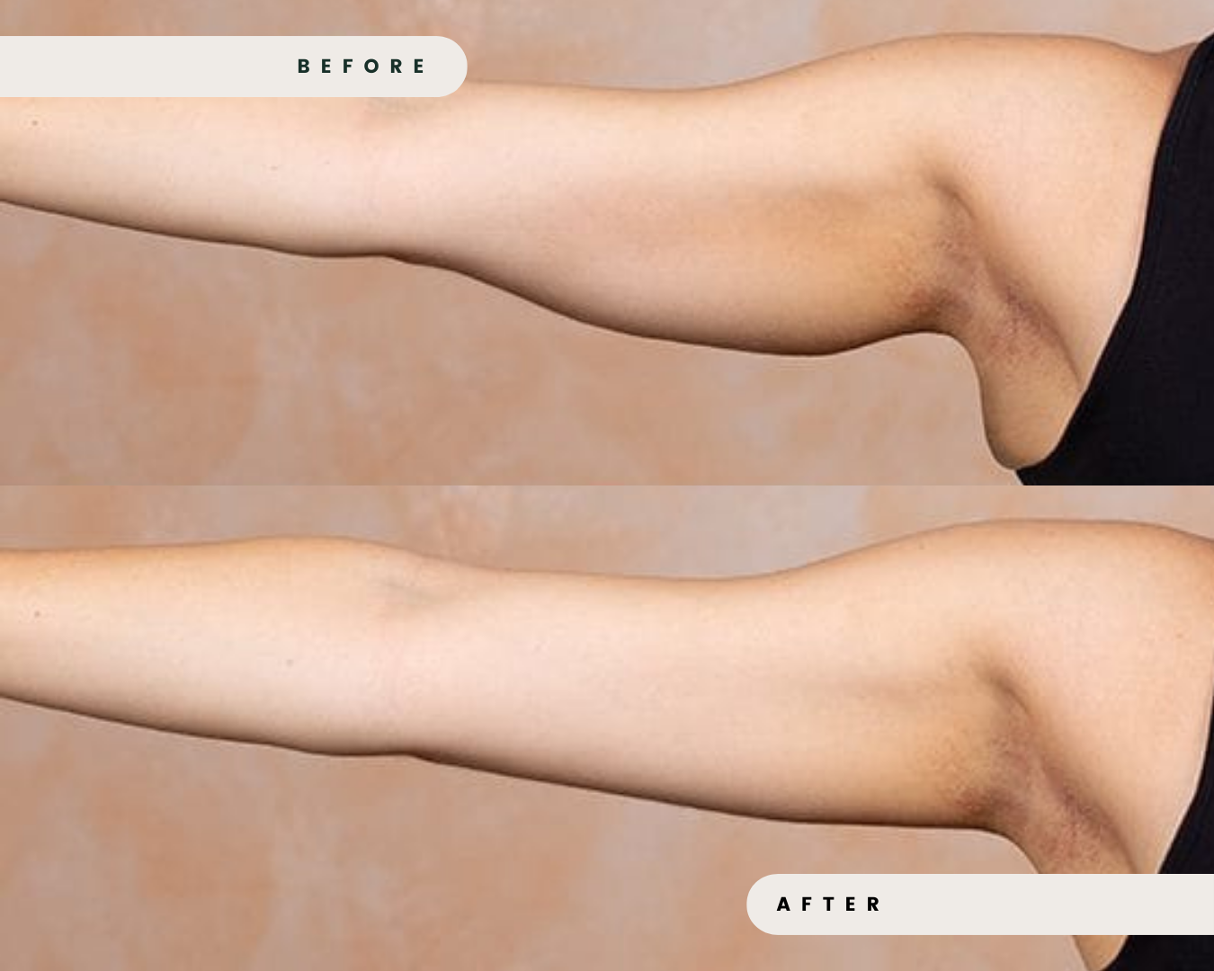 TRUSCULPT_FAT_REDUCTION_4_34d6c1be-c2c7-4d2a-8332-5bf8e3fe516a.png