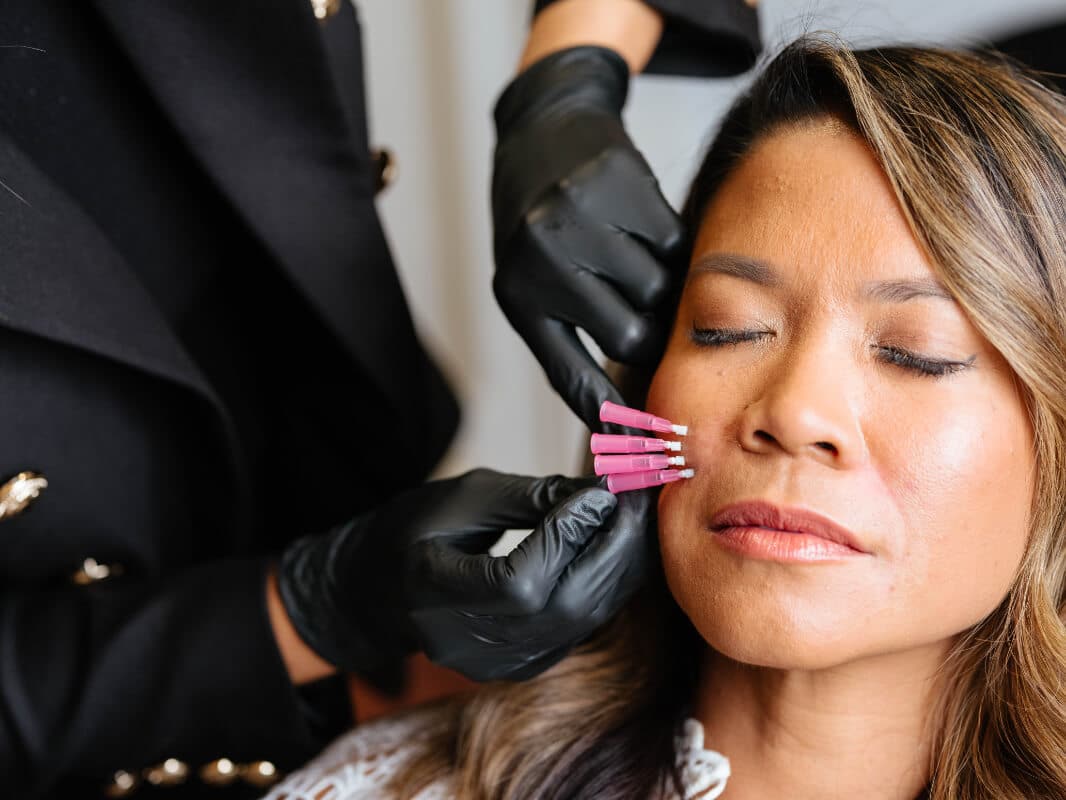 Mel Hornery, owner of Mel Hornery Cosmetics, expertly administering PDO mono threads to a model in one of the leading skin clinics.